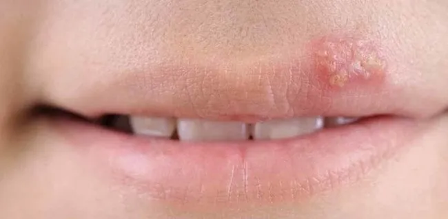 dudaktaki ucuklar nasil gecer neden