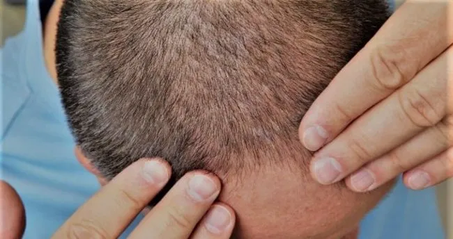 sac kaybi icin uygulanan lazer tedavisinin avantajlari nelerdir saglik haberleri