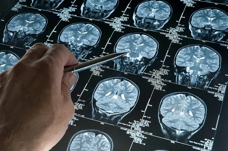Belirtileri Alzheimer hastalığı ile karıştırılabilir! Hidrosefali hastalığı nedir?