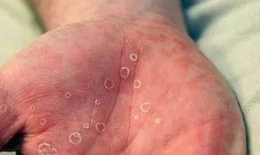 sifiliz nedir belirtileri nelerdir