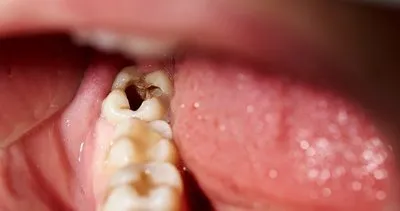 Bu besin diş çürüğüne engel oluyor! İşte diş çürüğüne engel olan mucizevi besinler