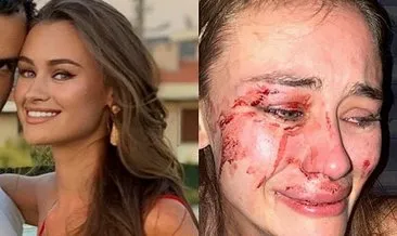 Dehşet görüntülerinden son dakika: Şeyma Subaşı’nın model arkadaşı Daria Kyryliuk saldırıya uğradı! Daria Kyryliuk açıklama yaptı!
