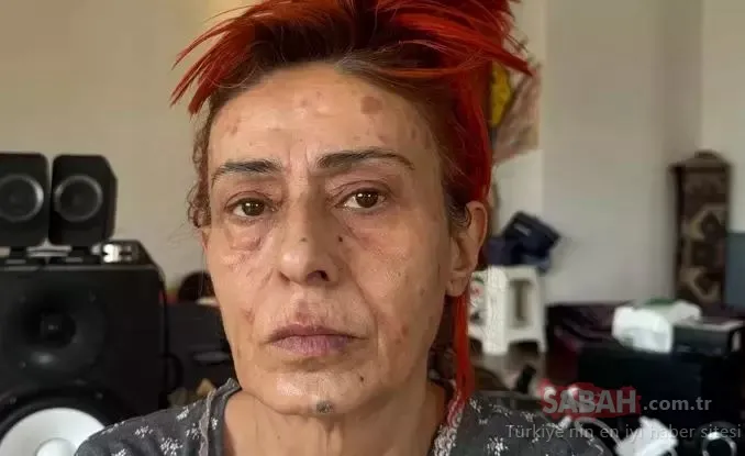 ‘Uyuduğu için yüzü yandı’ iddialarına cevap verdi! Tanyeli’nin gecesinde ortaya çıkan Yıldız Tilbe: Boya kötüymüş!