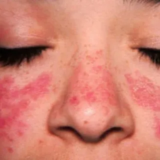 Lupus hastalığı belirtileri nelerdir? Lupus hastalığı neden olur, bulaşıcı mıdır?