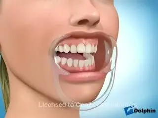 Dis Teli Nasil Takilir Videosunu Izle Son Dakika Haberleri