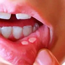 geniz akintisina ne iyi gelir nasil