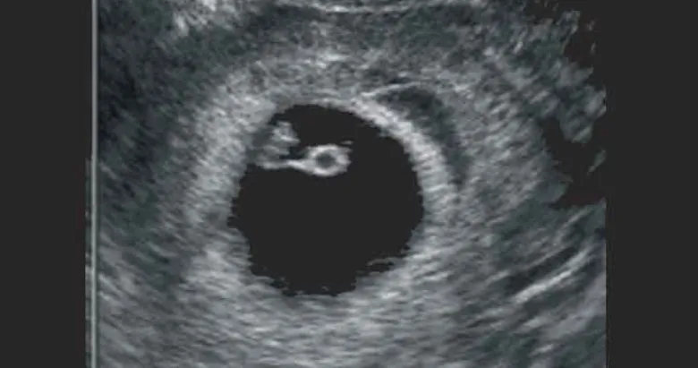 hafta hafta ultrason goruntuleri galeri bebegim ve biz