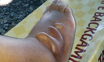 Ayağına düşen ’aslan balığı’ öldürüyordu