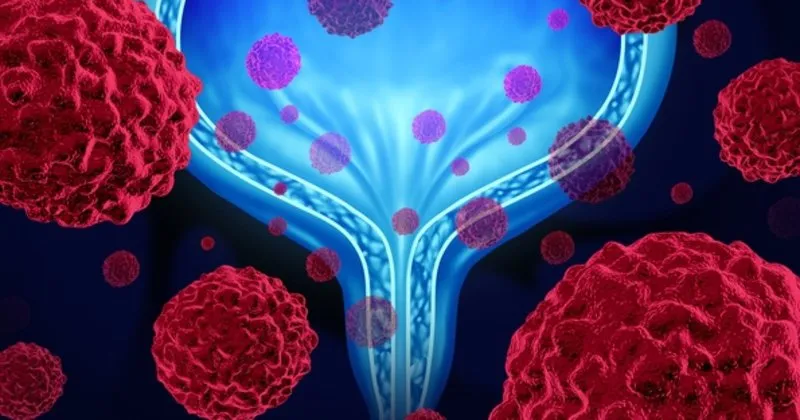 mesane kanseri son evre belirtileri