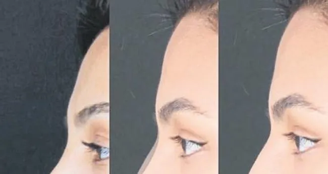 burun ameliyati ile hem estetik hem