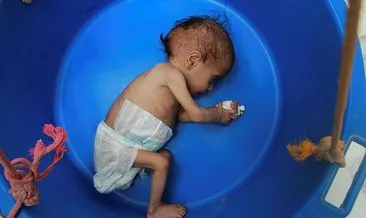 BM: Yemen’in güneyinde 98 bin çocuk ölüm riskiyle karşı karşıya