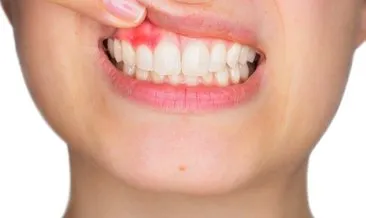 Diş uçlarının şeffaflaşması neden olur, doğal ve bitkisel tedavi ile nasıl geçer? Diş uçlarındaki şeffaflığa ne iyi gelir?