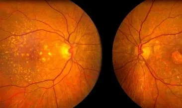 Gözde sarı nokta hastalığı belirtileri nelerdir? Sarı nokta hastalığı neden olur, nasıl geçer?