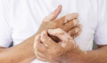 Vitiligo hastalığı ve tedavi yöntemleri