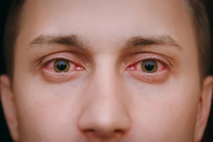 goz alerjisi nedir goz alerjisinin belirtileri nelerdir sayfa 5 saglik haberleri