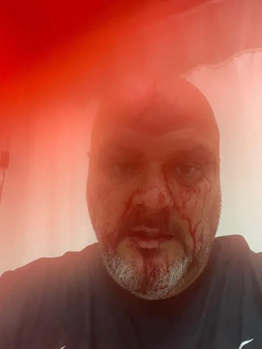 Ev sahibi kiracısını beyzbol sopasıyla dövdü! İstediği para dudak uçuklattı!