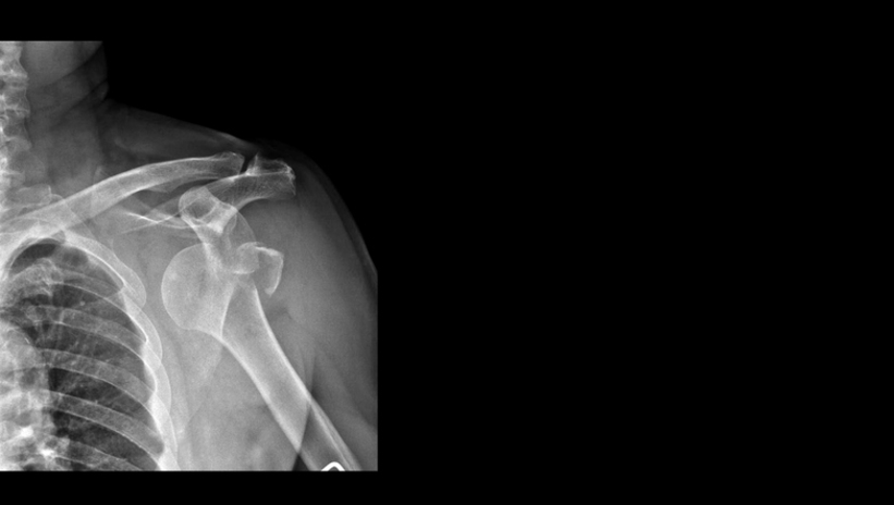 Omuz çıkığına dikkat! Yaşayanların %90’ı...