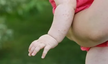 Bu durum çocuklarda gıda alerjisi riskini düşürebilir