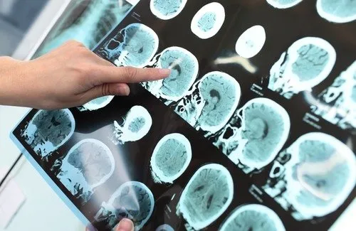 Bu araştırma Alzheimer hastalarına umut oldu