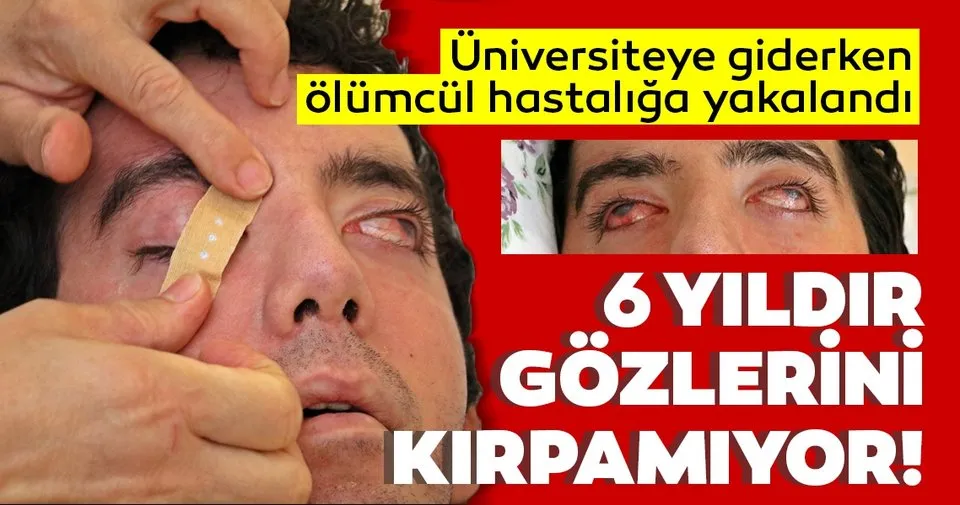 Son Dakika Goz Kapaklarini Kirpamiyor Sspe Hastasi Olan Halil Ozelik Gozlerini Yara Bandi Ile Son Dakika Yasam Haberleri Son Dakika Goz Kapaklarini Kirpamiyor Sspe Hastasi Olan Halil Ozelik Gozlerini Yara Bandi Ile Son Dakika Yasam Haberleri