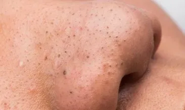 vucuttaki siyah noktalar nasil gecer siyah nokta tedavisi saglik haberleri