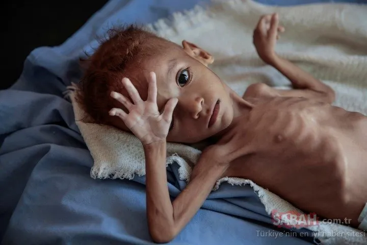 Yemen’de yaklaşık 85 bin çocuk yetersiz beslenmeden ölmüş olabilir