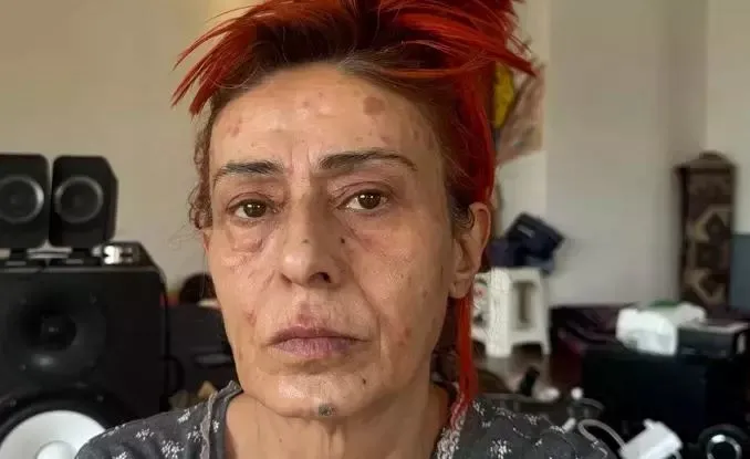 Saç boyası yüzünü yakmıştı! Yıldız Tilbe şimdi de yüzündeki beneklerle gündem oldu...