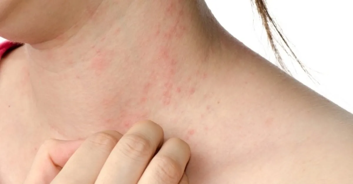 Kovid 19 Un Ilk Bulgusu Deri Dokuntusu Olabilir Saglik Haberleri