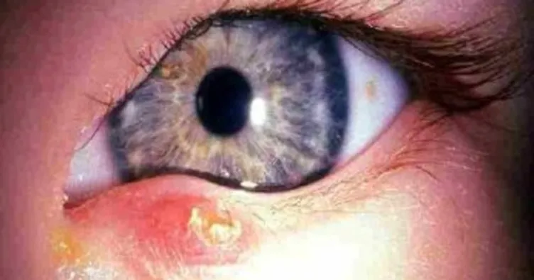 Arpacığa ne iyi gelir? Doğal tedavi ile arpacık nasıl geçer? Ne zaman doktora gidilir?