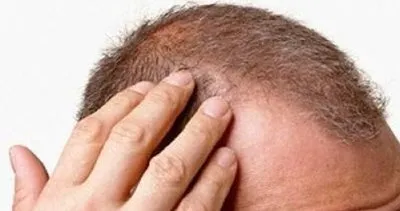 Saçkıran nedir? Nasıl tedavi edilir?