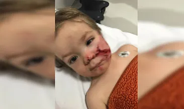 Ankara’da 1,5 ve 5 yaşındaki kardeşler pitbull saldırısına uğradı