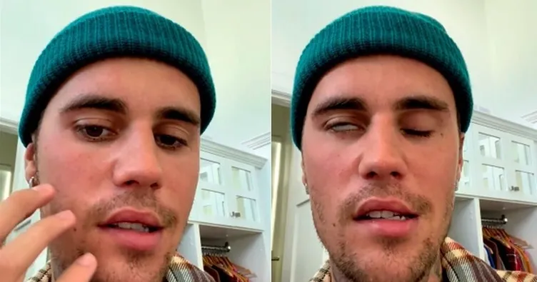 RAMSAY HUNT SENDROMU nedir, belirtileri nelerdir, tedavisi var mı? Justin Bieber’ın hastalığı nedir, Ramsay Hunt sendromu iyileşir mi?