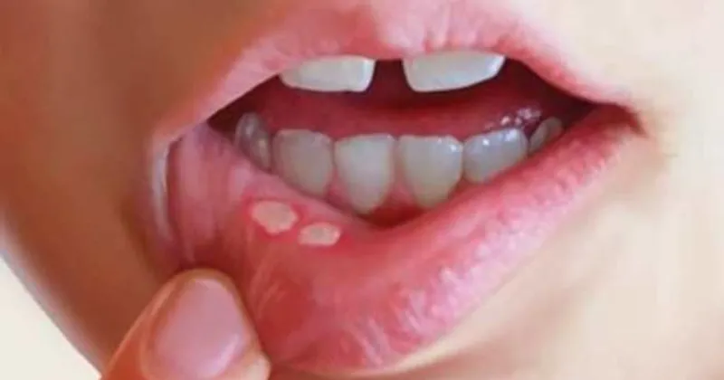 agiz ici yaralarina ne iyi gelir agiz yarasi nasil gecer saglik haberleri agiz ici yaralarina ne iyi gelir agiz yarasi nasil gecer saglik haberleri