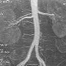 İlk başarılı böbrek nakli yapıldıı