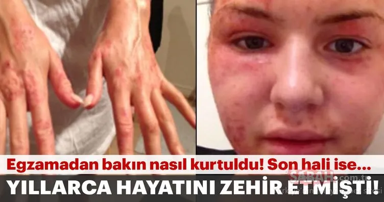 Çocukluğundan beri yaşadığı egzama sorununu böyle atlattı