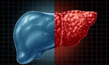Karaciğer yağlanması neden olur, doğal ve bitkisel tedavi ile nasıl geçer? Karaciğer yağlanması belirtileri ve tedavisi