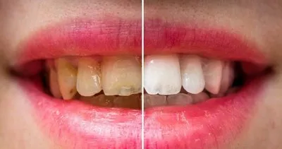 Bu yöntem sayesinde dişleriniz bembeyaz olacak! İşte dişleri beyazlatmanın kolay yolu