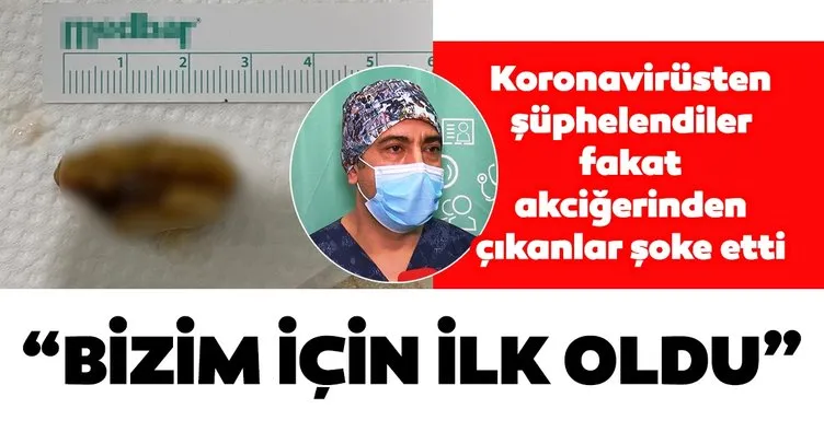 Bursa’da şaşırtan olay! Koronavirüsten şüphelenildi fakat akciğerinden ceviz çıktı