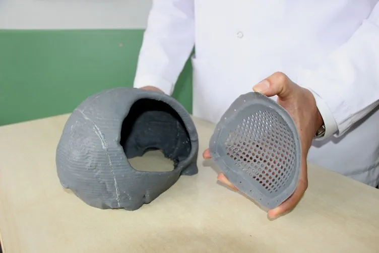 ’3D Yazıcı’ tekniğiyle kafasına titanyum parça takıldı