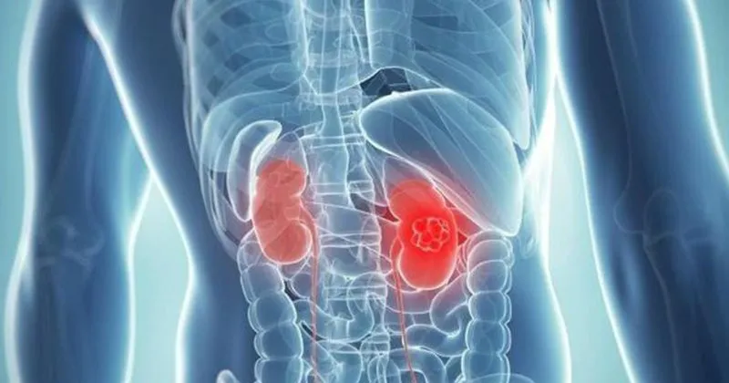 bobrek tasi nedir bobrek tasi neden