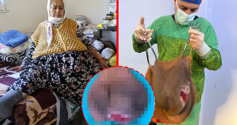 Gün geçtikçe büyüdü! Doktorlar bile gözlerine inanamadı: Karnından tam 40 kilo çıktı!