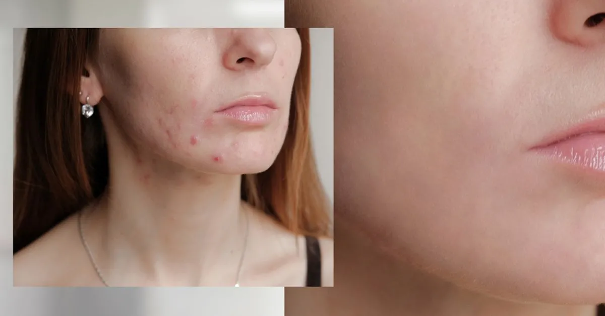 Sivilcelere Kesin Cozum Sivilceye Ne Iyi Gelir Yuzdeki Sivilce Izleri Nasil Gecer Sabah Haber Ofisi