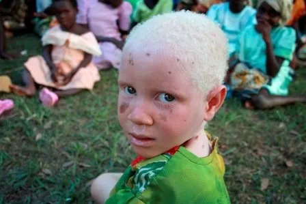 Kenya’daki albinolar büyücülerin kıskacında