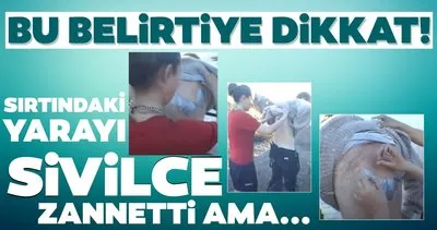 Sırtındaki sivilceleri yara diyerek önemsemedi! Ancak sivilcenin içinden çıkanlar şoke etti