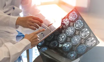 MS hastalığı için tedavi yöntemleri