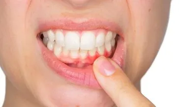 Diş İltihabı Vücuda Yayılma Belirtileri Nelerdir? Diş Kökü İltihabı Nerelere Vurur, Vücudu Nasıl Etkiler?