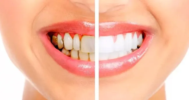 Diş Taşı Temizliği Fiyatı-Diş Temizleme Fiyatları Ne Kadar, Kaç Seans Sürer?