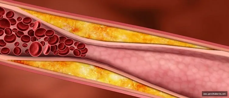 Damar tıkanıklığı belirtileri neler? Damar tıkanıklığı nedir?