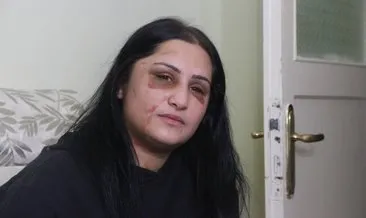 Samsun’da eşi tarafından darp edilen kadın hastaneden taburcu oldu! Kızımın çığlıklarına dayanamadım