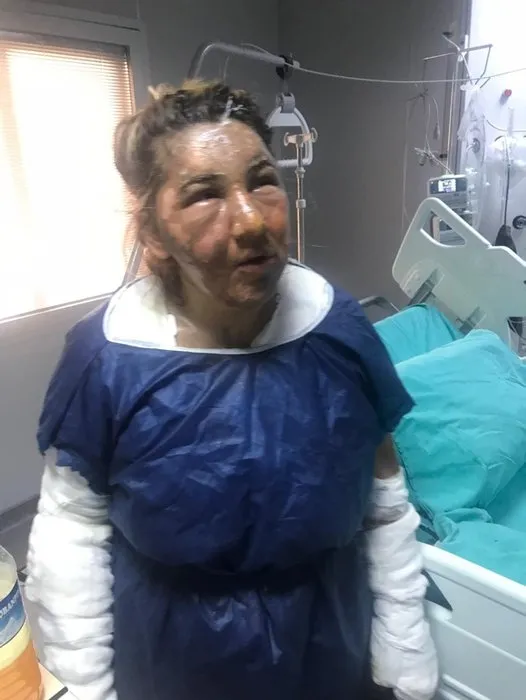 İstanbul’da vahşet: Cezaevinden izinli çıktı, eski eşini kızgın yağ ile yaktı